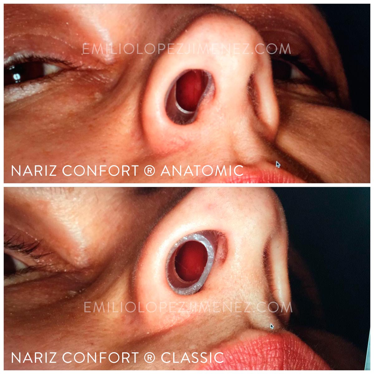 Nariz Confort Classic vs Anatomic