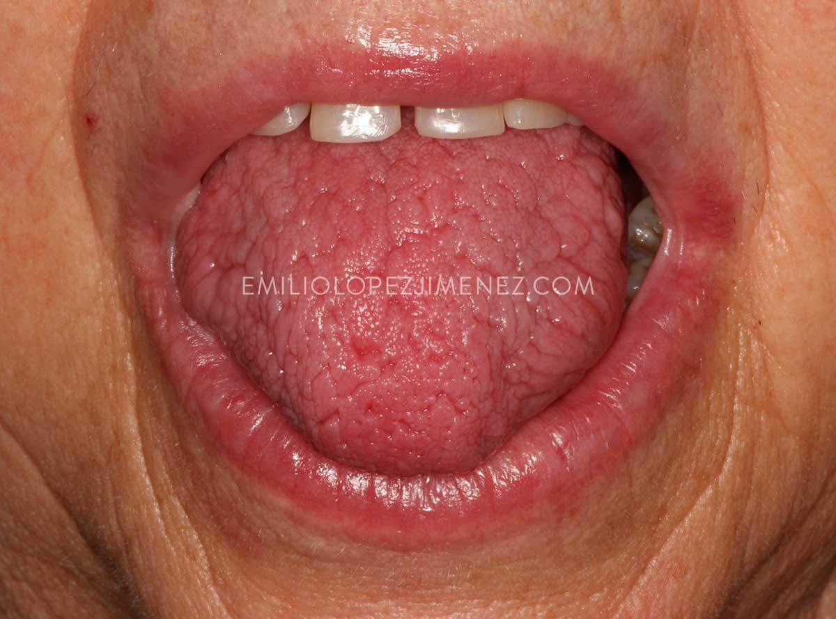 Mujer adulta con boca seca y labios cortados tratada en Clínicas Dentales Dr. Emilio López Jiménez